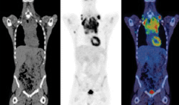 Image:  Pre-treatment image of a patient with uptake in a mediastinal mass (Photo courtesy of Dr. Sally Barrington, London’s St. Thomas’ PET Imaging Center, UK).